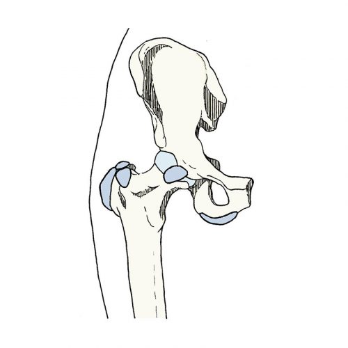 Síndrome Doloroso Trocantérico