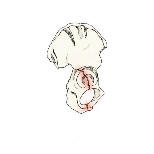 Fraturas do acetábulo e anel pélvico