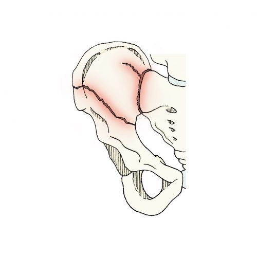 Fraturas do acetábulo e anel pélvico