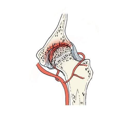 Necrose avascular da cabeça do fémur