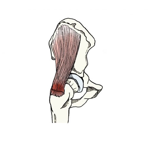 sindrome trocanterico