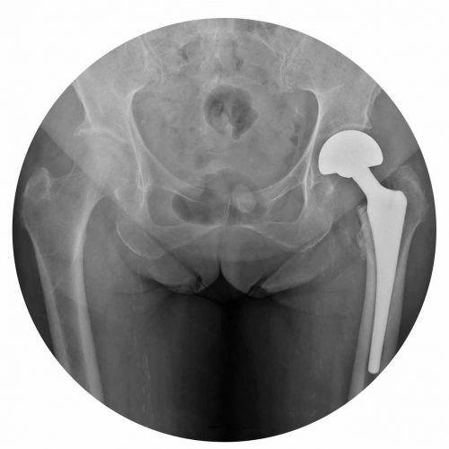 Artroplastia Parcial Anca
