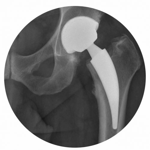 Artroplastia Total Anca