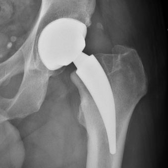 Artroplastia Total da Anca