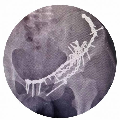 Osteossíntese Acetábulo Anel Pélvico