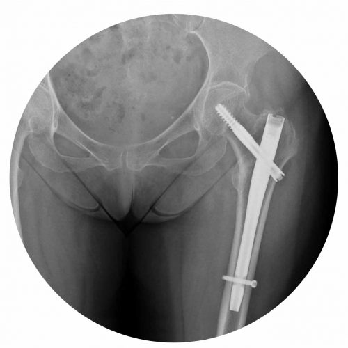 Osteossíntese Colo Fêmur