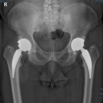 Artroplastia Bilateral da Anca