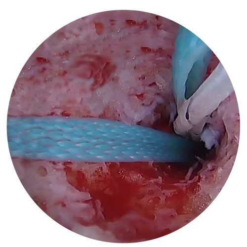 Sutura Tendinosa Artroscópica