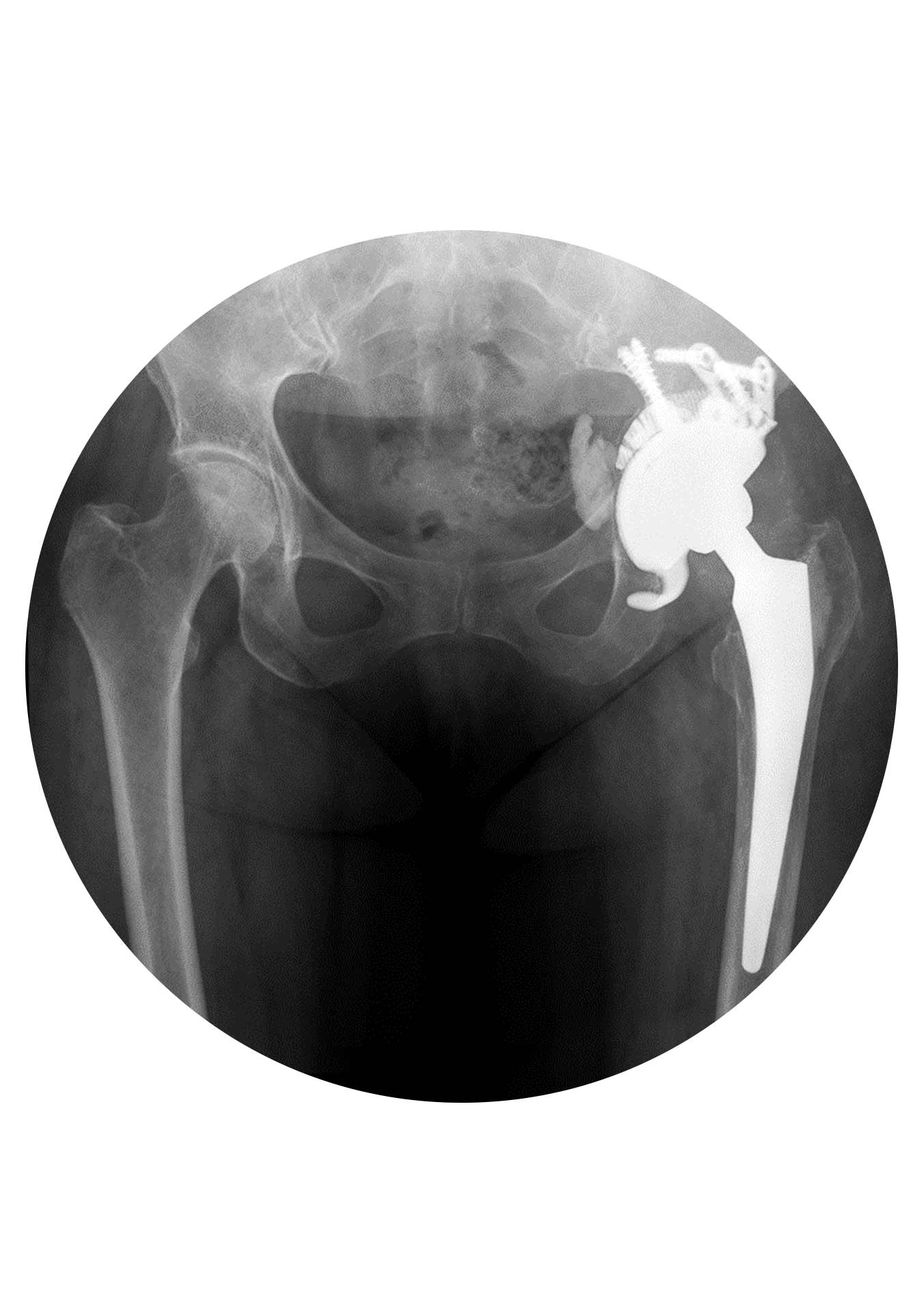 Artoplastia Revisão da Anca