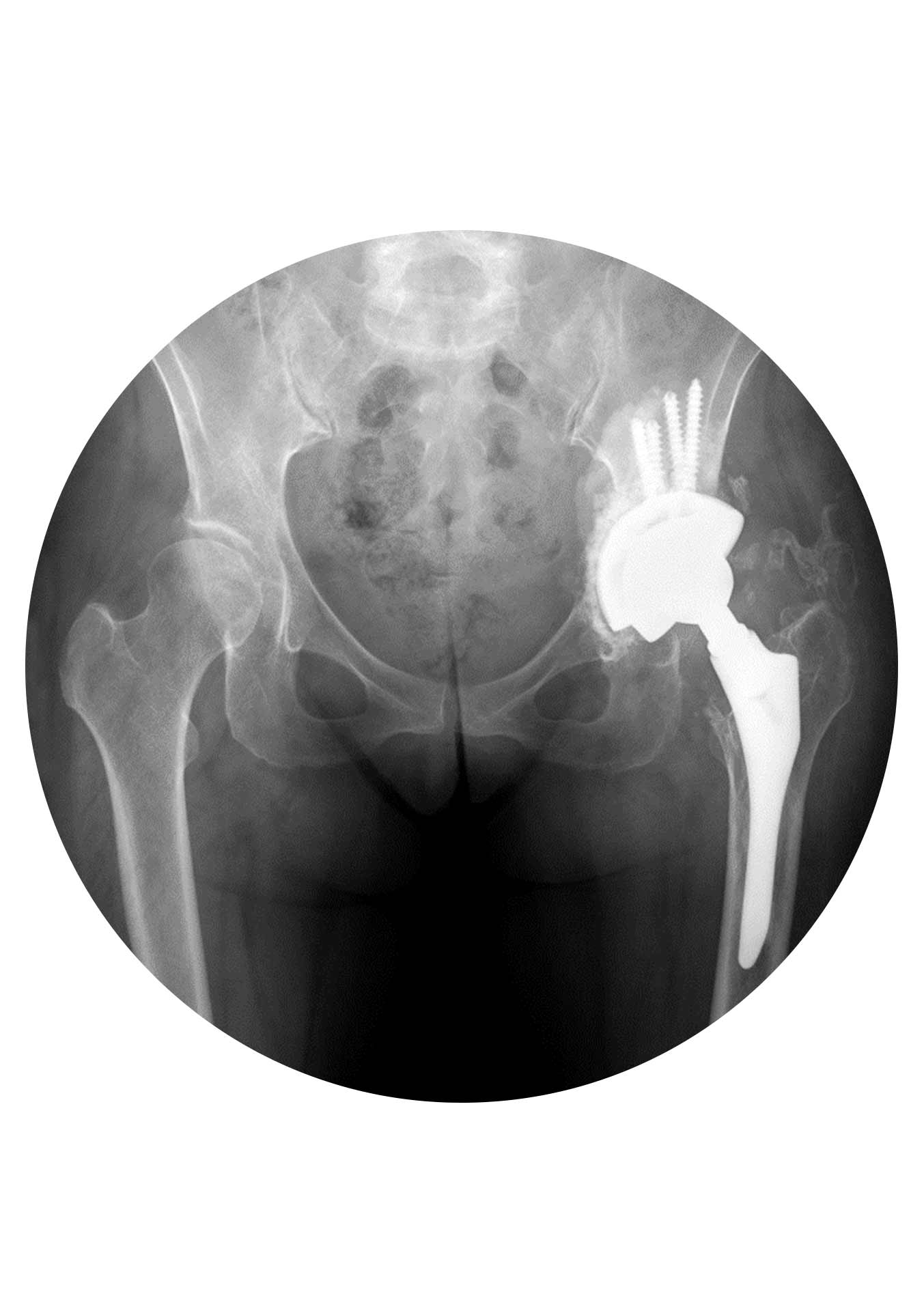 Artoplastia Revisão da Anca