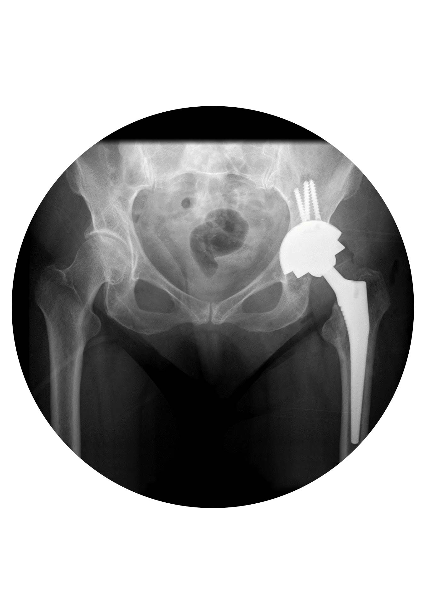 Artoplastia Revisão da Anca