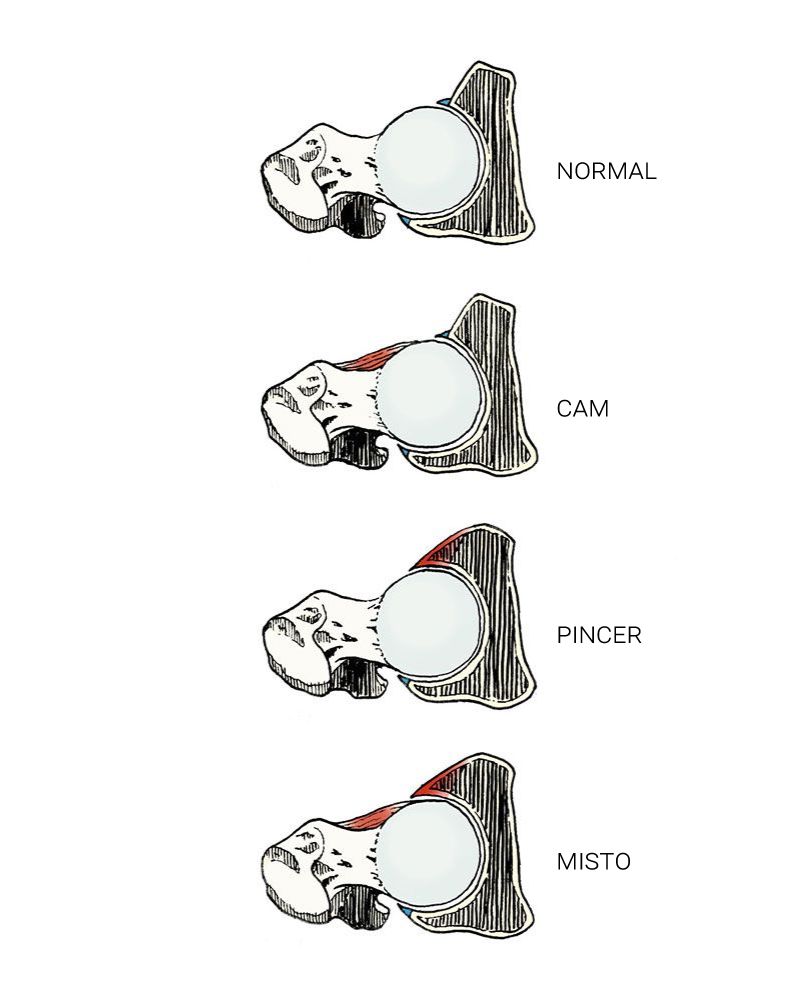 Conflito Femoro-Acetabular, CFA